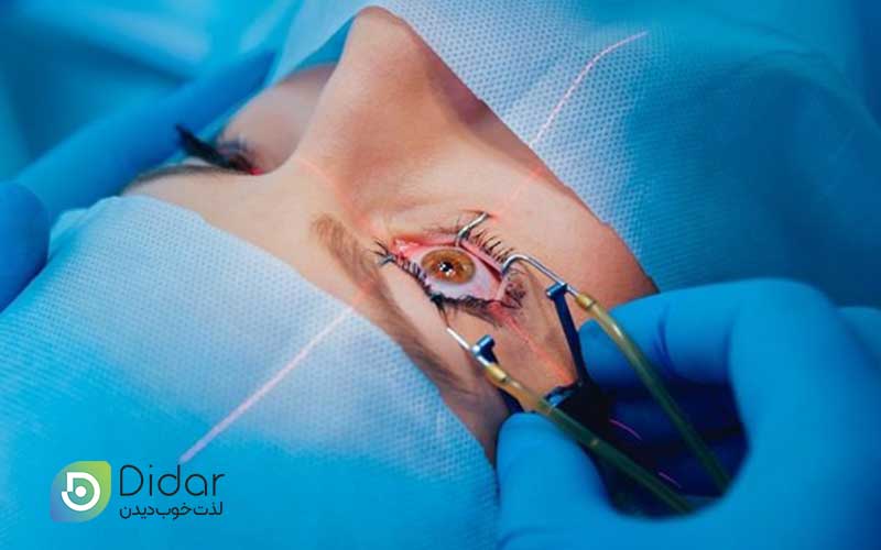 عمل-لیزیک-چشم-چیست-و-برای-چه-کسانی-مناسب-است-کلینیک-چشم-دیدار