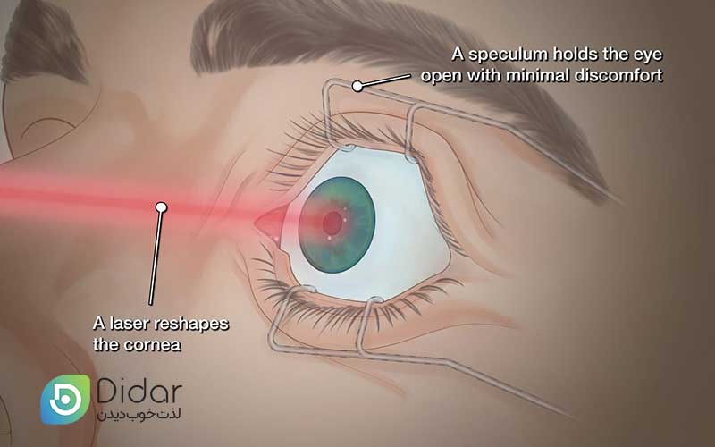 به-دلایل-زیر-ممکن-است-PRK-را-به-جای-لیزیک-انتخاب-کنید-کلینیک-چشم-دیدار