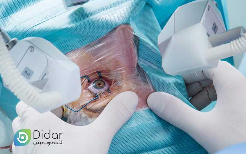 عمل-لازک-چشم-(PRK)-یک-جراحی-سرپایی-است-یا-نیاز-به-بستری-دارد-کلینیک-چشم-دیدار