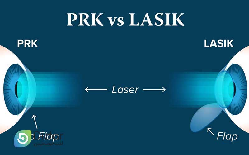 عمل-لازک-چشم-یا-PRK-کلینیک-چشم-دیدار