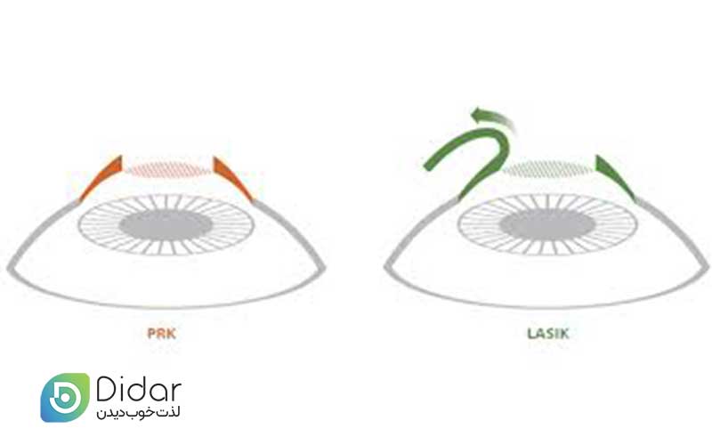 چه-کسانی-می-توانند-عمل-لازک-چشم-(PRK)-را-انجام-دهند-کلینیک-چشم-دیدار