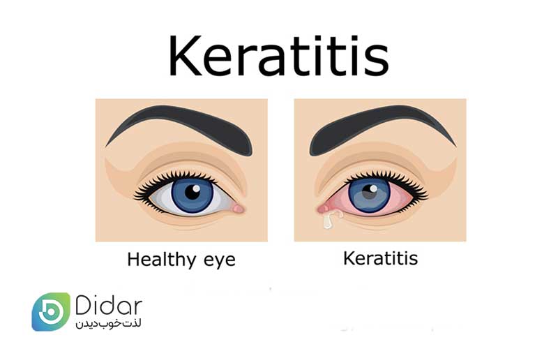 کراتیت-چشم-یا-التهاب-قرنیه-چیست-کلینیک-چشم-دیدار