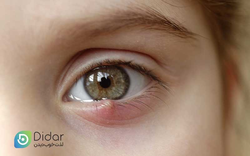 گل-مژه-چیست؟-آشنایی-با-علل-به-وجود-آمدن،-علائم-و-درمان-گل-مژه