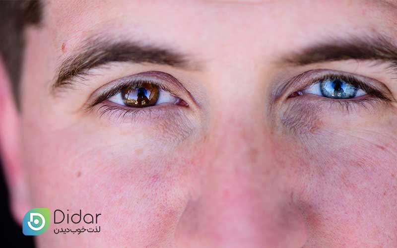 هتروکرومیا-یا-هم-رنگ-نبودن-چشم-ها-چیست؟-بیماری-زیبایی-چشم-ها