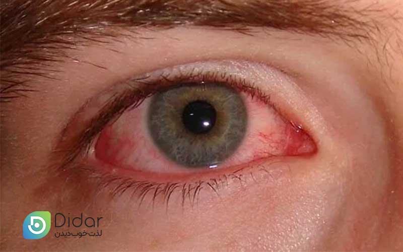 آیا-التهاب-ملتحمه-قابل-پیشگیری-است