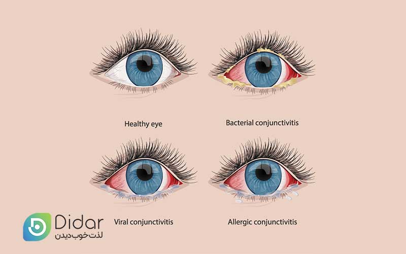 دلایل-ایجاد-چشم-صورتی