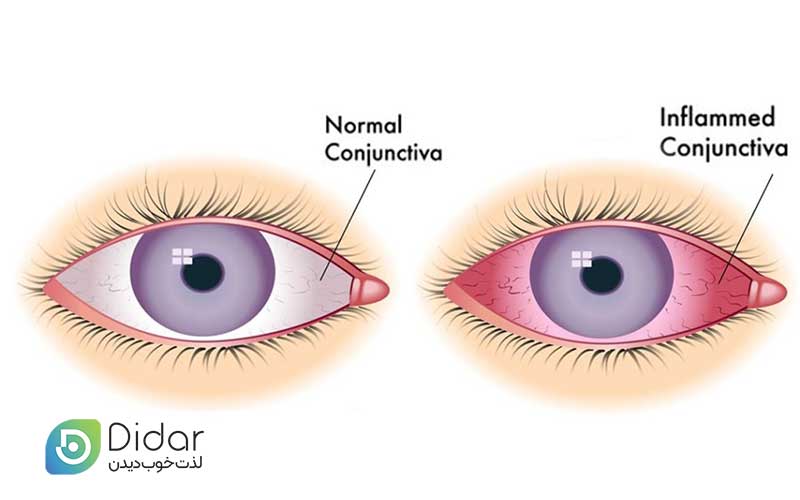 راه-های-درمان-التهاب-ملتحمه