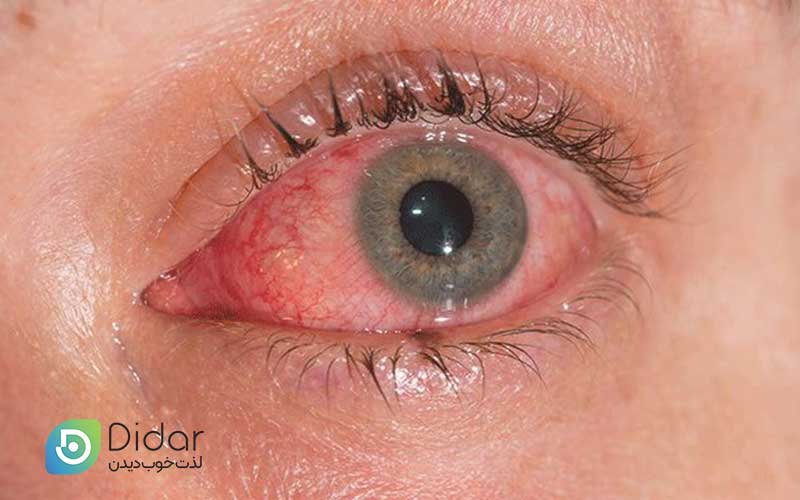 علائم-التهاب-ملتحمه-چیست