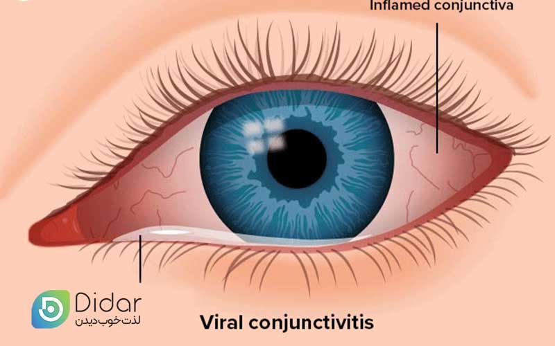 عوارض-چشم-صورتی