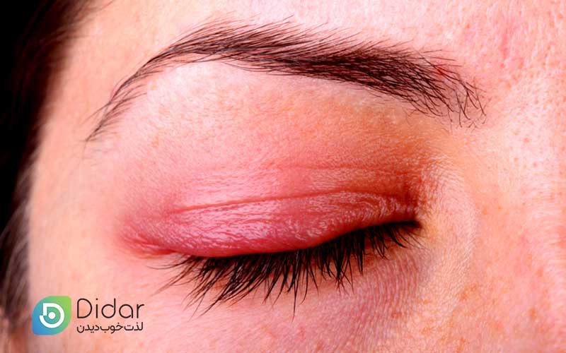 بیماری-روزاسه-چشمی-چیست؟