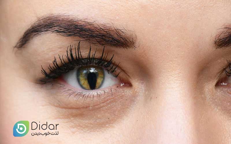 بیماری-کلوبوما-چیست؟