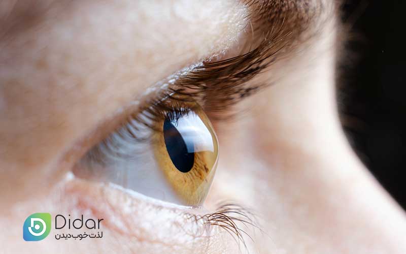 آیا-قوز-قرنیه-باعث-کوری-می-شود؟