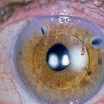 کثیف-شدن-لنز-داخل-چشم
